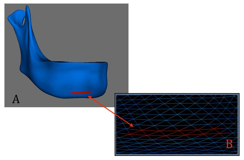 Material e Método 68 Figura 9 - A. ROI Mento demarcada na região mentoniana triângulos na malha 3D. B.