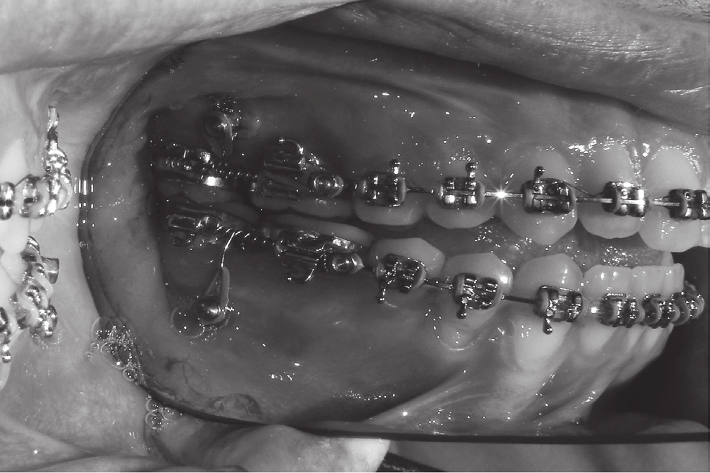 Figura 8 Radiografia periapical evidenciando o mini-implante instalado