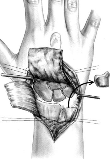 Etapa 2. Exposição da Articulação A cápsula do punho dorsal é levantada como um retalho retangular baseado distalmente.