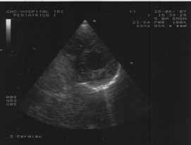 Figure 1. Transthoracic echocardiogram, parasternal short-axis view, of the ventricles in systole, showing prominent trabeculae separated by deep recesses in the left ventricular cavity.