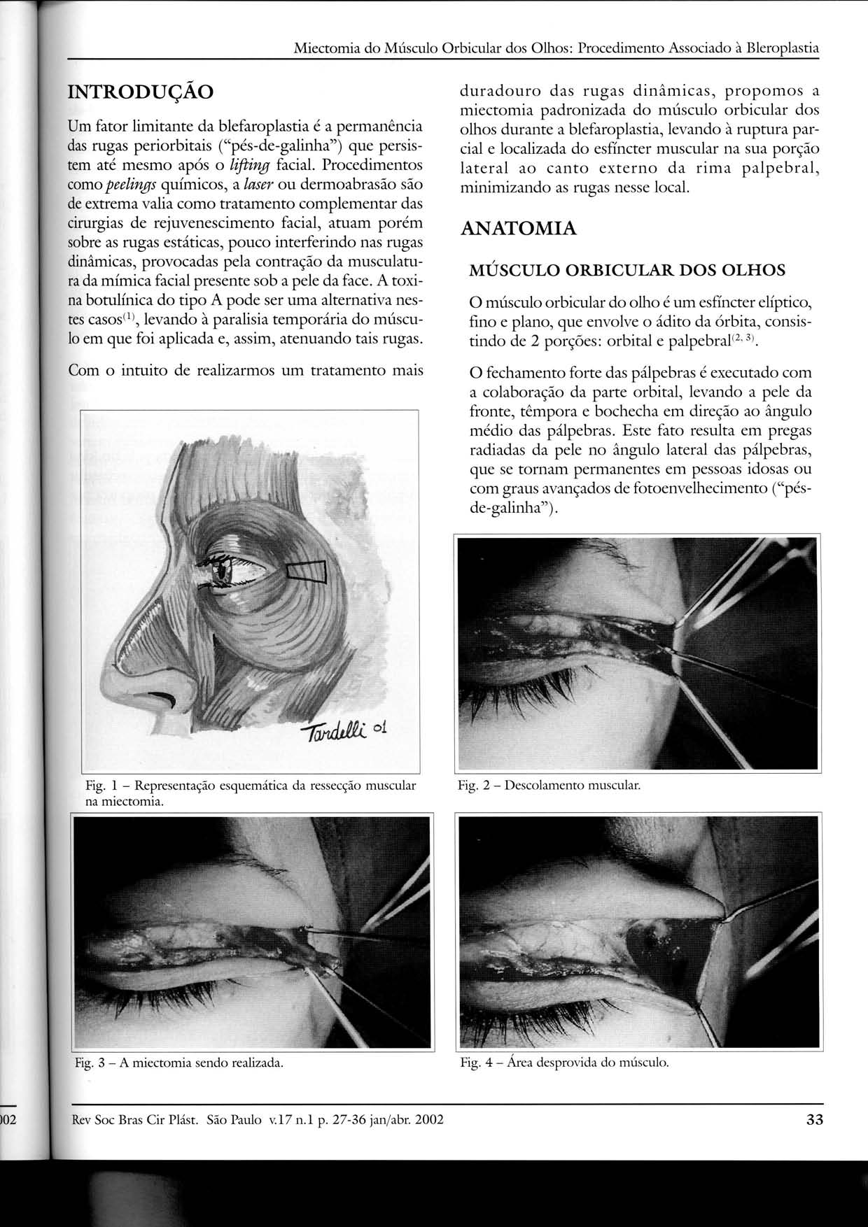 Miectomia do Músculo Orbicular dos Olhos: Procedimento Associado à Bleroplastia INTRODUÇÃO Um fator limitante da blefaroplastia é a permanência das rugas periorbitais ("pés-de-galinha") que persistem