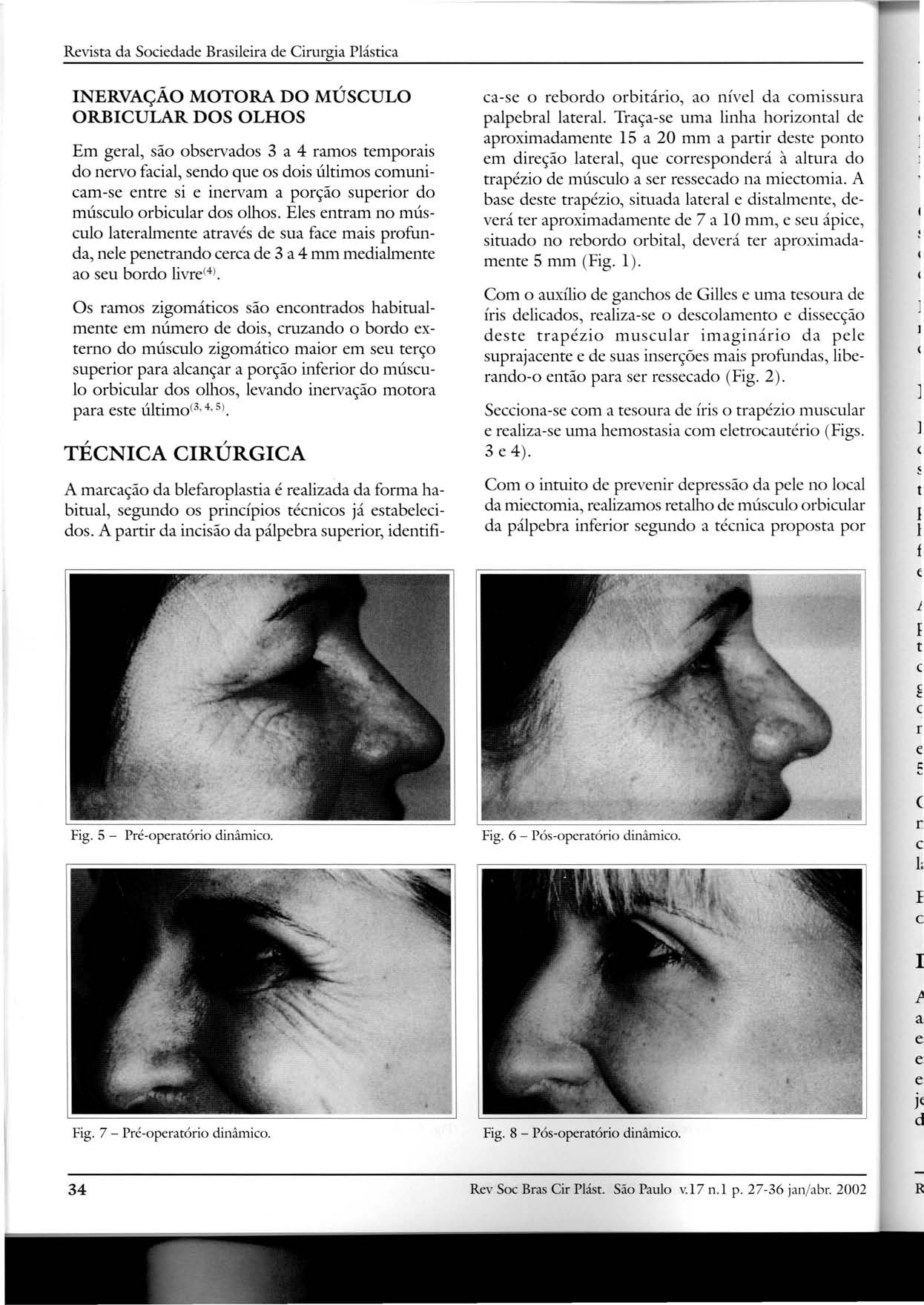 Revista da Sociedade Brasileira de Cirurgia Plástica INERVAÇÃO MOTORA DO MÚSCULO ORBICULAR DOS OLHOS Em geral, são observados 3 a 4 ramos temporais do nervo facial, sendo que os dois últimos
