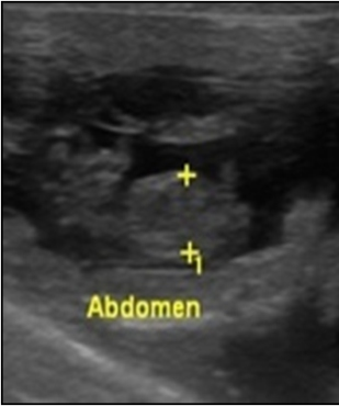 A: vesícula embrionária (VE) (39 DAP); B: espessura da placenta (EP) (3 DAP); C: diâmetro biparietal (DBP) (5 DAP); D: diâmetro abdominal (DA) (5 DAP). 3 A B C D a DAP.