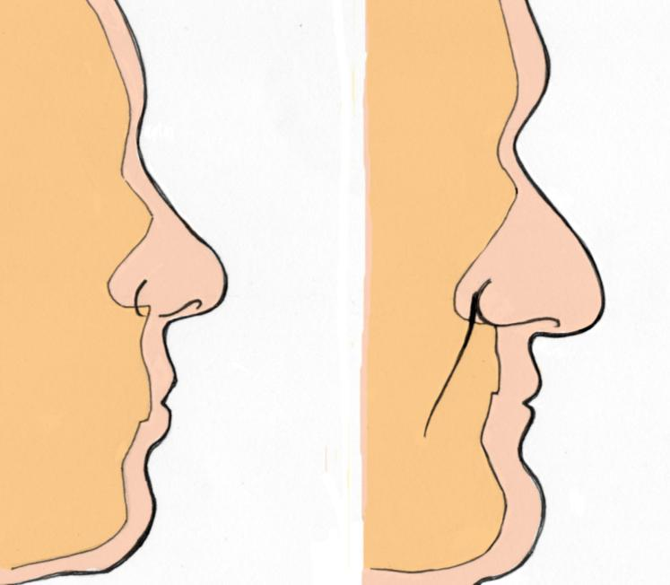 A B Figura 39- Comparação do perfil da face jovem A com o perfil da face envelhecida B. Em B observa-se uma abertura piriforme maior, a deiscência do lóbulo nasal e a formação do sulco nasogeniano.