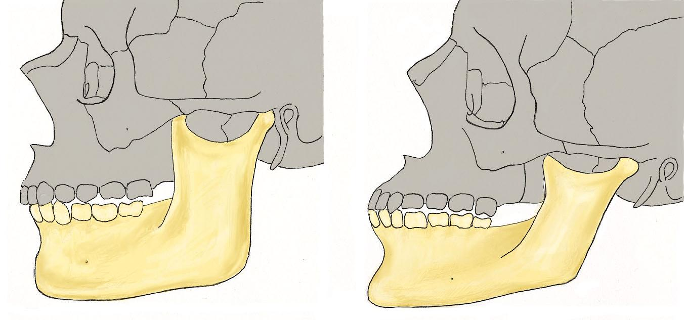 Figura 40- Com o envelhecimento a altura do ramo e do corpo da mandibula diminuem, aumentando o angulo que estas fazem entre si, tal como ilustra a linha vermelha.