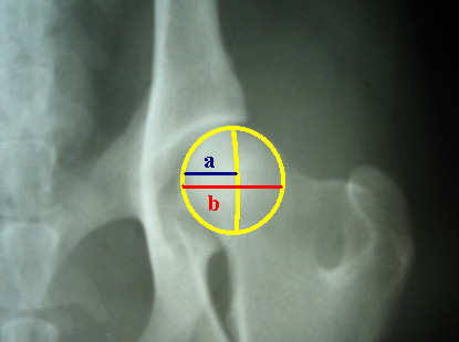 E 145º Figura 5- Detalhe da imagem radiográfica da articulação coxofemoral de cão, ilustrando como o percentual de cobertura da cabeça do fêmur (PC) é calculado [PC= (a b) x 100].