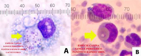 Na urinálise foi observada a presença de cetonúria leve (1+), bilirrubinúria moderada (2+), proteinúria moderada (100 mg/dl), quantidade moderada de cilindros granulosos, bacteriúria severa e piúria