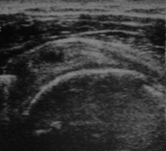 Supraespinal: Corte longitudinal do tendão do m. supraespinal apresentando área circular hipoecogênica no interior do tendão, compatível com ruptura parcial das fibras.