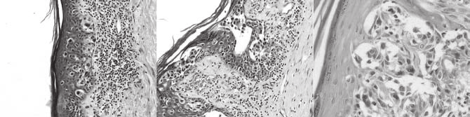 No material designado como linfonodo sentinela, foram dissecados três linfonodos de aspecto reacional, livres de metástases histológicas.