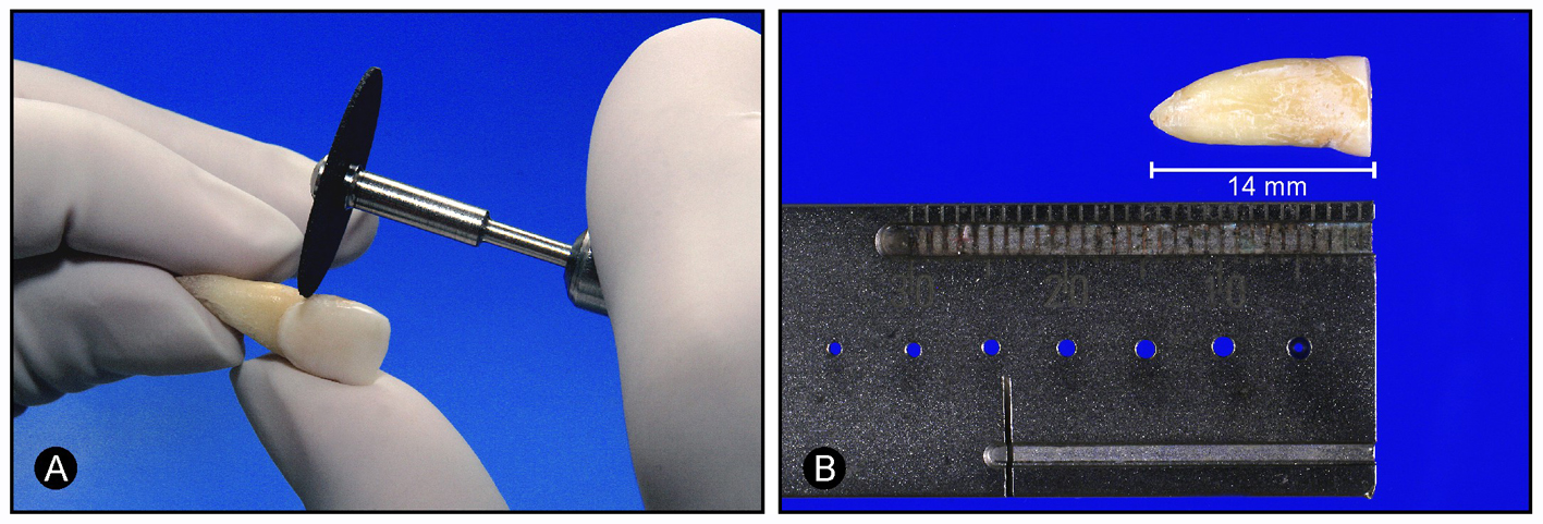Material e métodos 37 A confecção do batente apical foi realizada com 3 instrumentos acima do diâmetro anatômico anteriormente determinado (limas 45, 50, 55).