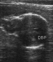 26 K.C.M. MELO et al. Figura 1 - Imagem da vesícula e do embrião ecogênico. 33 dias antes do parto (25 dias após cobertura ou IA), transdutor 7,5 MHz, em cadelas Chow-Chow.