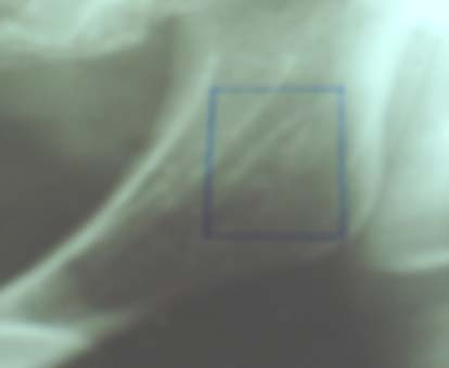 19 - Radiografia panorâmica com transparência mostrando a demarcação nos ramos da mandíbula direita e esquerda. Fig.