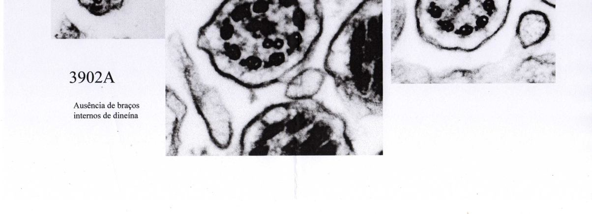 Transposição de pares de microtubulos Irregularidades dos filamentos radiais Alteração da