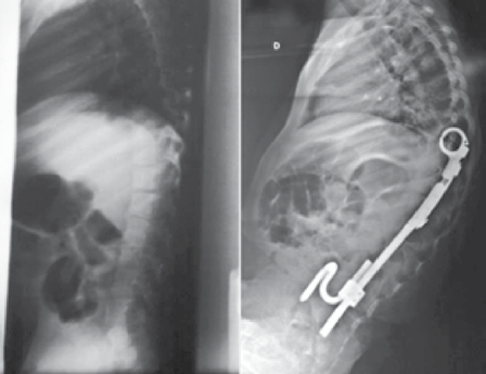 184 Lateral Figura 2. Radiografias pré e pós-operatórias evidenciando a ocorrência de cifose juncional. mento de distração efetuado.