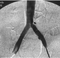 O paciente não recebeu transfusão sanguínea durante o ato cirúrgico e foi transferido desperto para a Unidade de Terapia Intensiva. Figura 7 - Trombos removidos, com extensão superior a 80 cm.