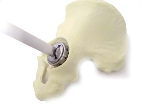 1. Fresagem da Cavidade Acetabular Com Fresa FR.14.