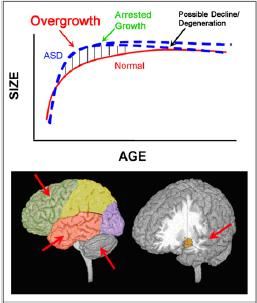 NEUROBIOLOGIA DO ESPECTRO AUTISTA Aceleração do crescimento cerebral nas fases precoces do desenvolvimento, seguida de parada de crescimento mais tardiamente.