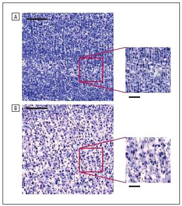 NEUROBIOLOGIA DO ESPECTRO AUTISTA Micrografia da área 4 de Broadman, lâmina III, de um paciente autista (A) e um de um