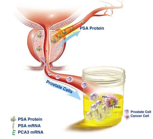 12 *Diagrama extraído do site: http://prostate-cancer.