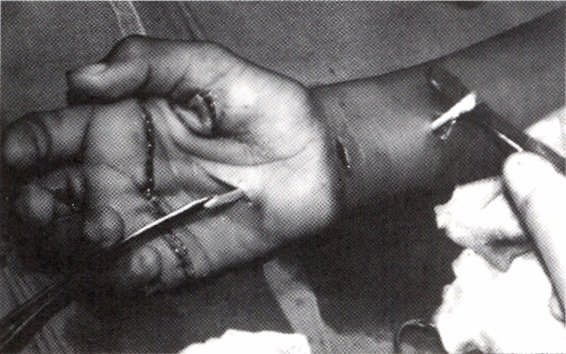 Fig. 26.14 Transferência corn o uso do flexor superficial. palmaris longus (Fig. 26.14).