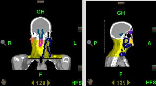 A cinzento encontra-se a imagem da TC de planeamento e a amarelo a imagem da TC da Tomoterapia.