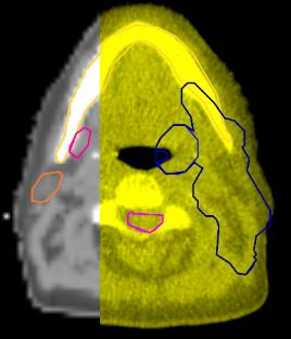 36: Representação gráfica de uma fusão de imagens no plano sagital do mesmo doente da figura anterior.