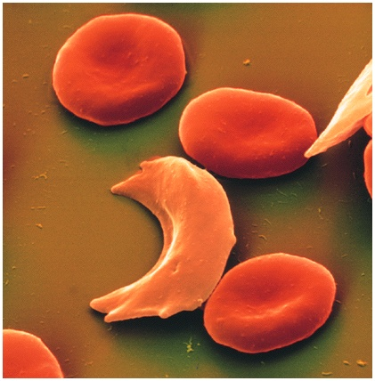 para a falciformização em baixas tensões de oxigênio Infecção de uma hemácia pelo parasita da malária Células falciformes são filtradas preferencialmente no baço
