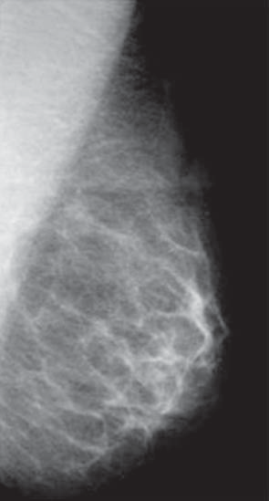 Controle de qualidade e artefatos em mamografia Figura 7. Écran molhado. A B Figura 8. Área de perda da definição na mamografia por bolha de ar entreposta entre o filme e o écran.