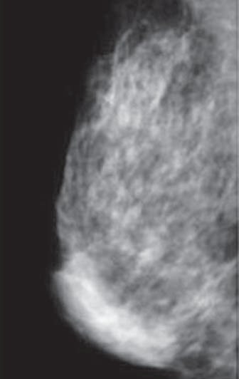 Nevus cutâneo simulando nódulo mamário. Figura 10.