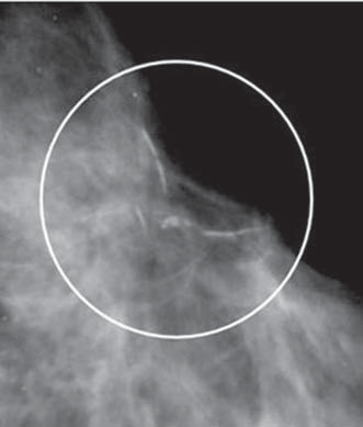 crânio-caudal do que nas incidências médio-lateral