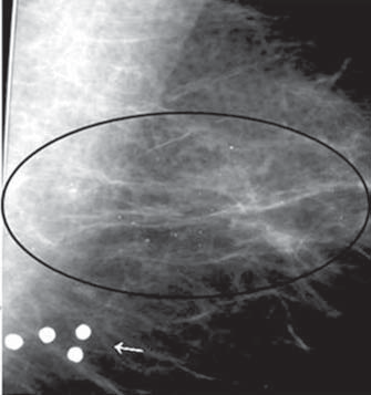 Controle de qualidade e artefatos em mamografia Figura 16. Fragmentos metálicos de projétil de arma de fogo simulando calcificações e microcalcificações.