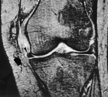 Em D, plano sagital ponderado em T2, notam-se estiramento do ligamento cruzado anterior (setas grossas), derrame articular (estrela) e edema do tecido celular subcutâneo anterior ao