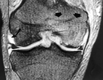 Em B, observa-se também pequeno derrame articular (seta curva).