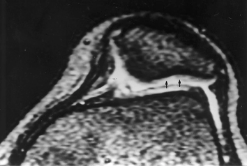 De Grossi CM et al. A B Figura 3. Em A, plano coronal ponderado em T1, observa-se fratura plurifragmentar do côndilo femoral medial (setas).