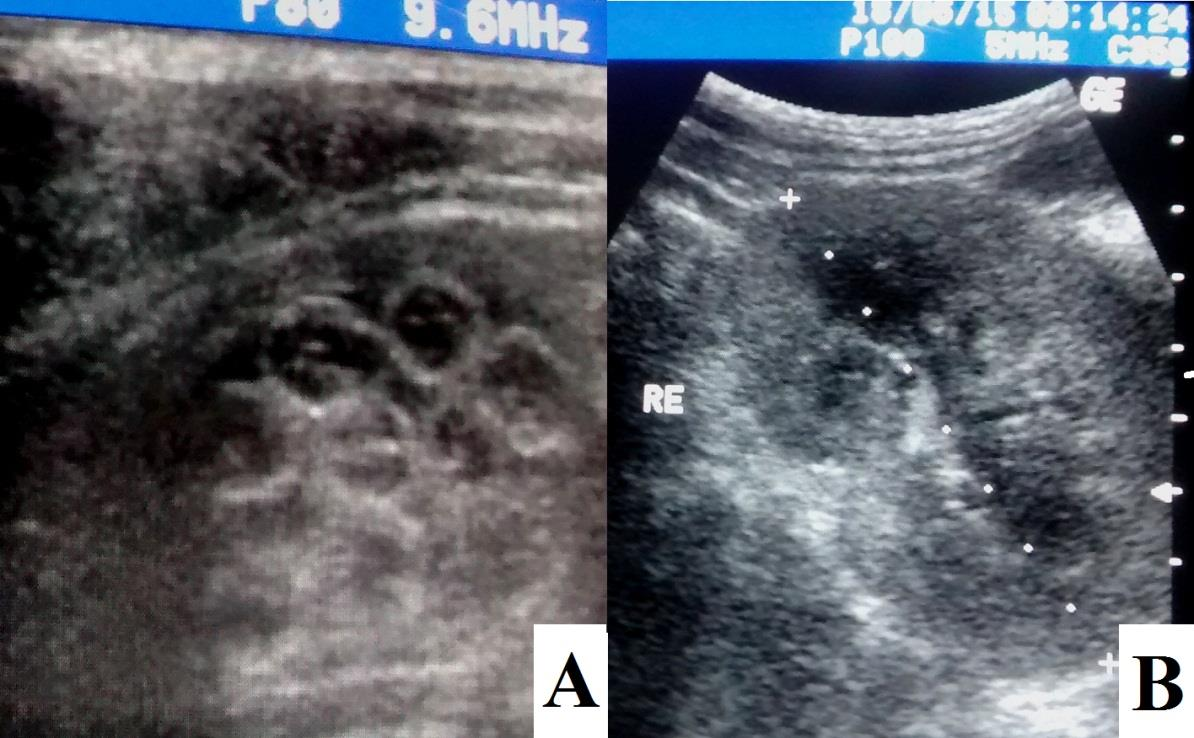 coletado sangue para análise hematológica, a fim de avaliar principalmente série vermelha, função renal e hepática, com o diagnóstico presuntivo de leptospirose e insuficiência renal, visto que o