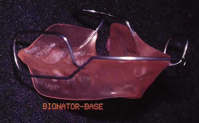 139 Figura 02: Visão lateral do Bionator Base (Fonte: Ortolani-Faltin e Faltin Jr., 1998). 2.1.2 Bionator Fechado O Bionator Fechado é idêntico ao Bionator Base com a diferença que a