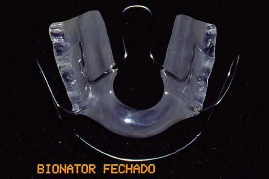 , 1998). O acrílico nas regiões anteriores superior e inferior não pode tocar os dentes e gengiva.