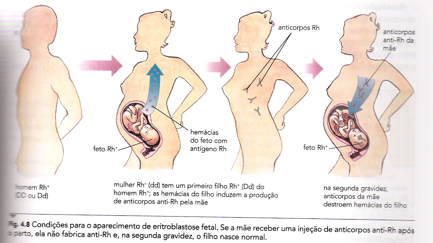 Eritroblastose Fetal: a