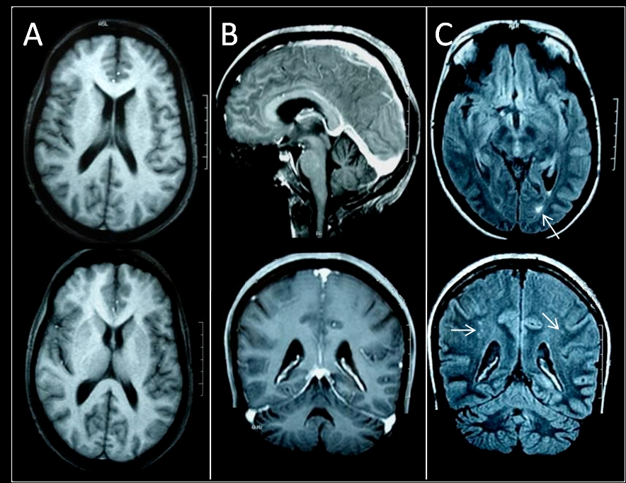 61 magnética (IRM) em 4 pacientes (casos 3, 4, 5 e 6). A presença de atrofia cerebral e cerebelar difusa foi encontrada em 4 pacientes (casos 3, 4, 5, e 6).