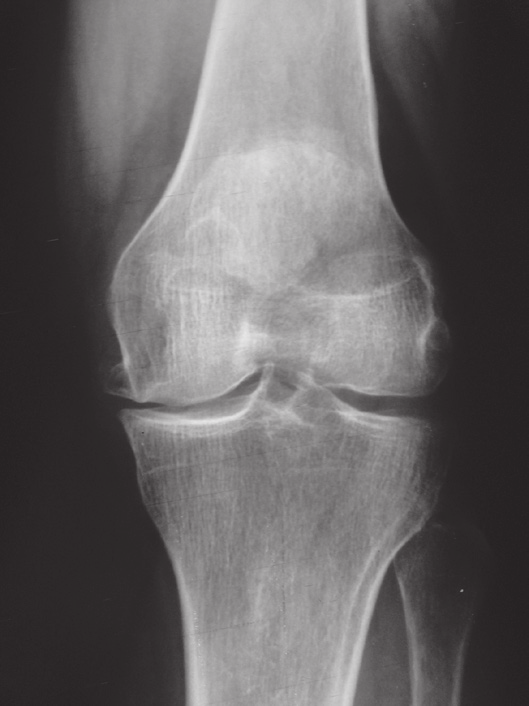 O atrito ósseo é caracterizado como ausência de espaço articular associada ao desgaste ósseo dessa articulação.