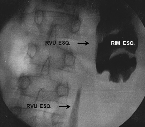 RELATO DO CASO Trata-se de paciente de 8 anos de idade com historia de cirurgia em outro estado após 1 ano de idade devido a hipospádia.