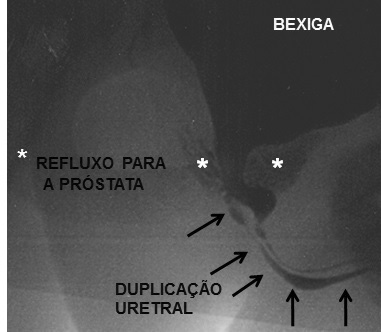 FIGURA 3 e 4 Uretrocistografia miccional pré-operatória.