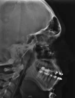 Foram obtidos, no mínimo, 6 fotografias do pré e pósoperatório com a visão frontal, oblíqua e lateral de ambos os lados. Esta metodologia foi validada previamente 8.