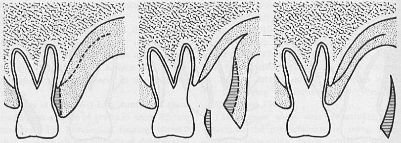 O retalho primário foi colocado no lugar, realizou-se pressão durante 2 minutos, suturou-se e não foi colocado nenhum curativo. (Edel, 1974) Figura 5: Diagrama de ilustração da técnica 1, no palato.