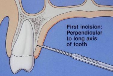 c. Técnica de Bruno ou Modificada Esta técnica tem como área dadora referida o palato, foi descrita por Bruno em 1994, consiste na realização de uma primeira incisão palatina, realizada