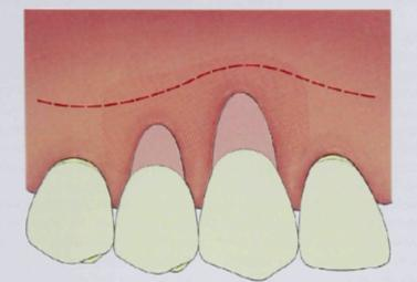 envelope. (Raetzke cit. in Zabalegui 1999) A vantagem deste procedimento é a cicatrização de início rápido, que resulta da ausência destas incisões externas.