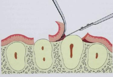 com curetas o tecido para o seu desbridamento, conservando o tecido gengival o mais possível para nutrir o enxerto. Figura 18: Visão vestibular das RG e áreas adjacentes.