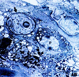 Presença de mastócitos (seta), fibroblastos (F) na região adjacente ao epitélio.