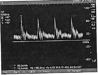 MEDIDAS Aplicadas a imagens congeladas MEDIDAS DOPPLER Velocidade (cm/s), gradiente de pressão 1. Numa traçado espectral doppler, pressione a tecla Medidas.