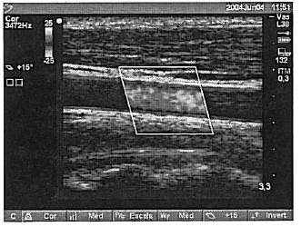 Cores (Doppler) 1. Pressione a tecla cores para utilizar os recursos de Cor. É exibida uma caixa da região de interesse (RDI) no centro da imagem 2D